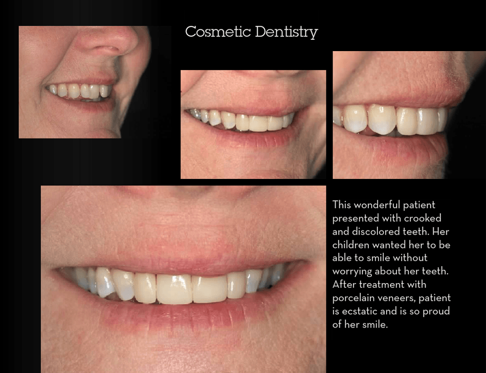 Smile Gallery Before and After Dental Care Associates