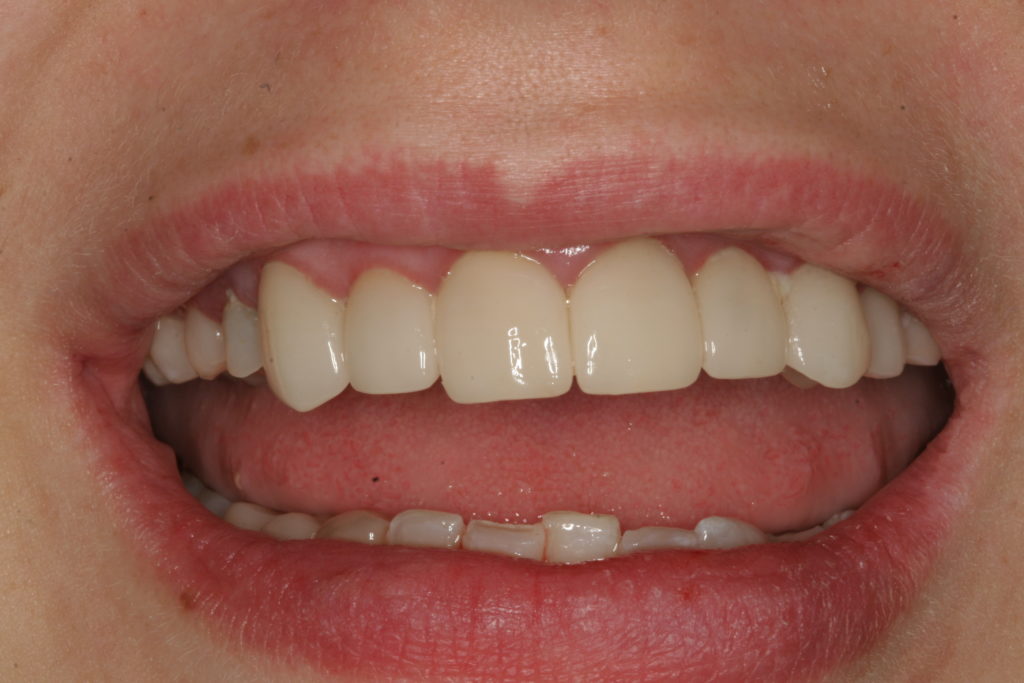 Before Teeth Whitening Dental Care Associates Minot ND