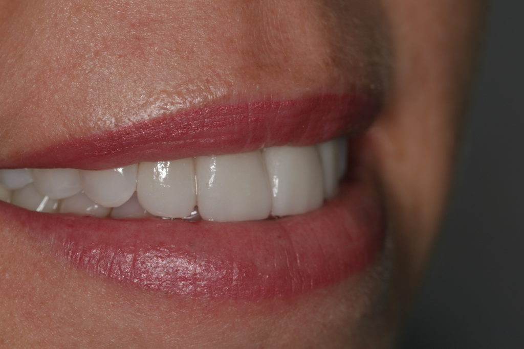 Smiling Mouth with Veneers Dental Care Associates Minot ND