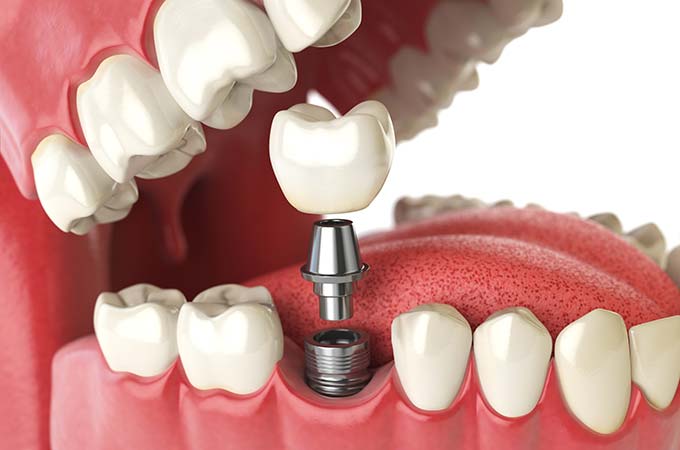 dental implant titanium post minot nd
